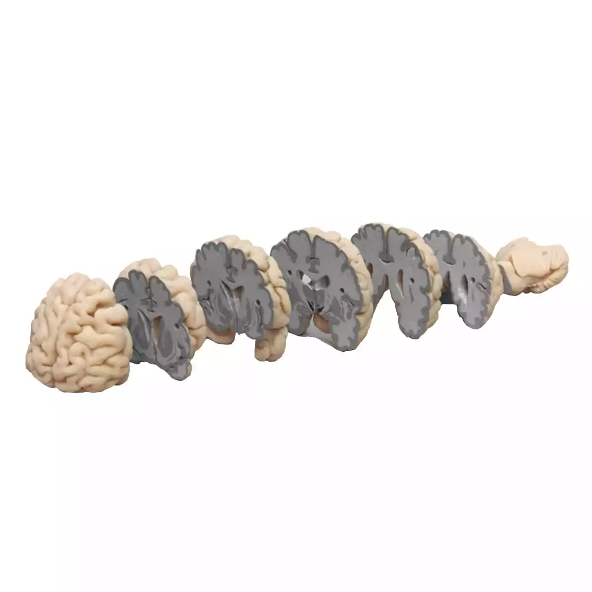  Cerveau humain en coupes frontales
