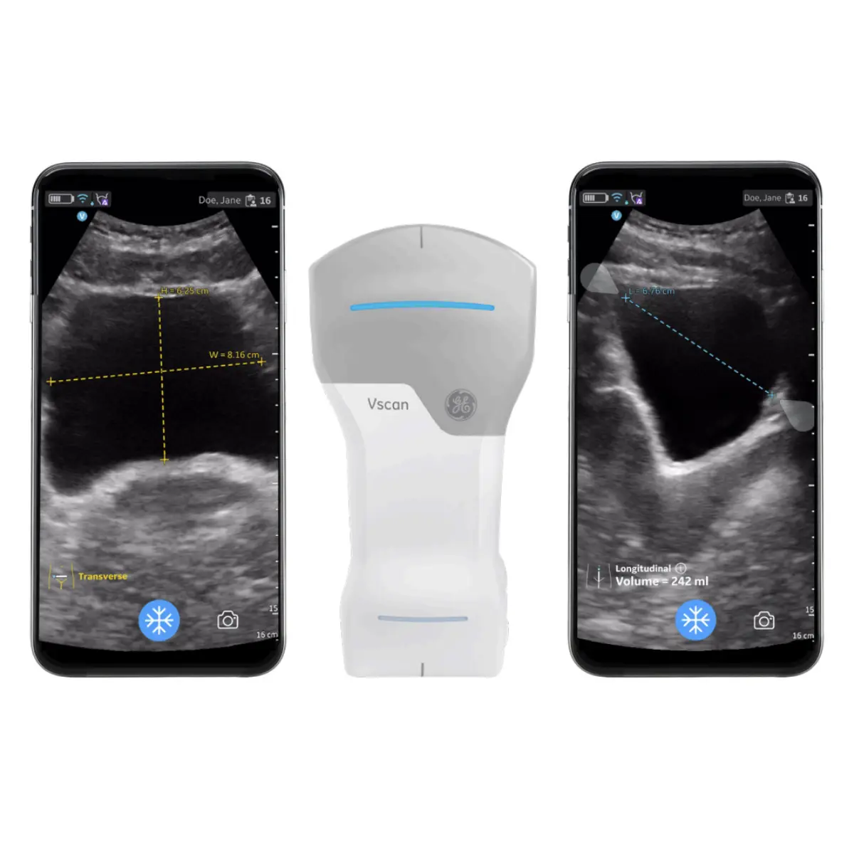  Mise à niveau Auto Bladder Volume pour Vscan Air CL