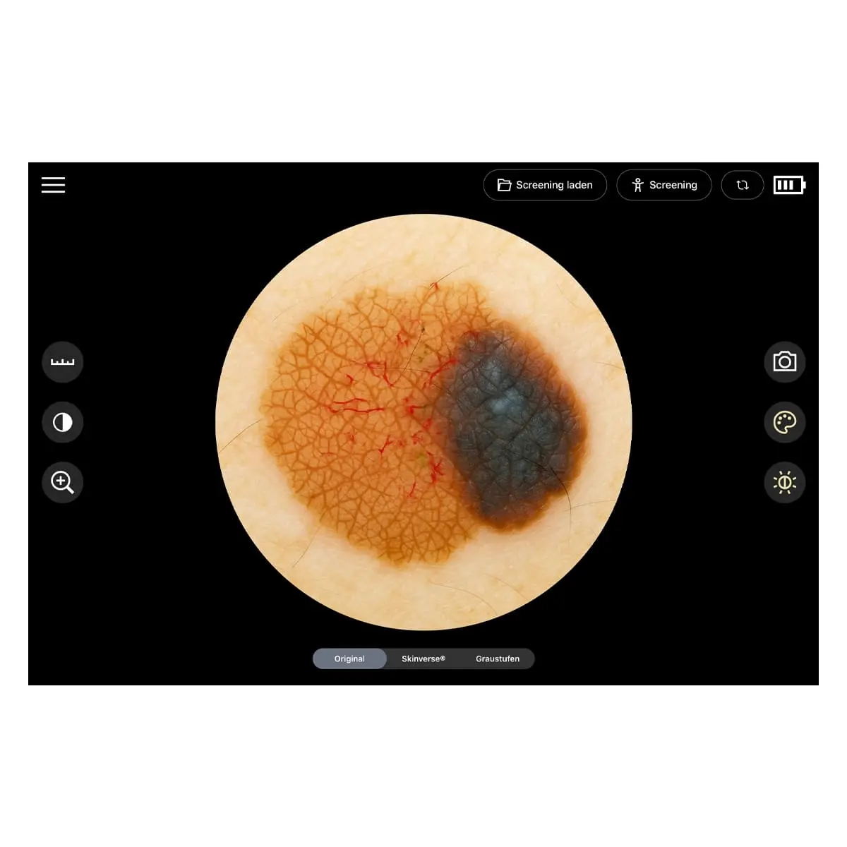  Dermatoscope numérique «Scaut®»