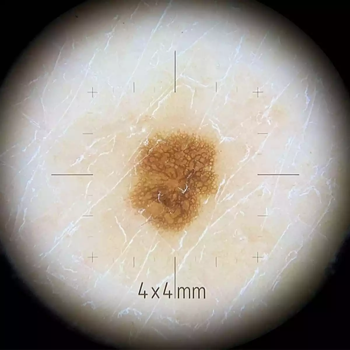  Petit embout de contact pour dermatoscope DL4