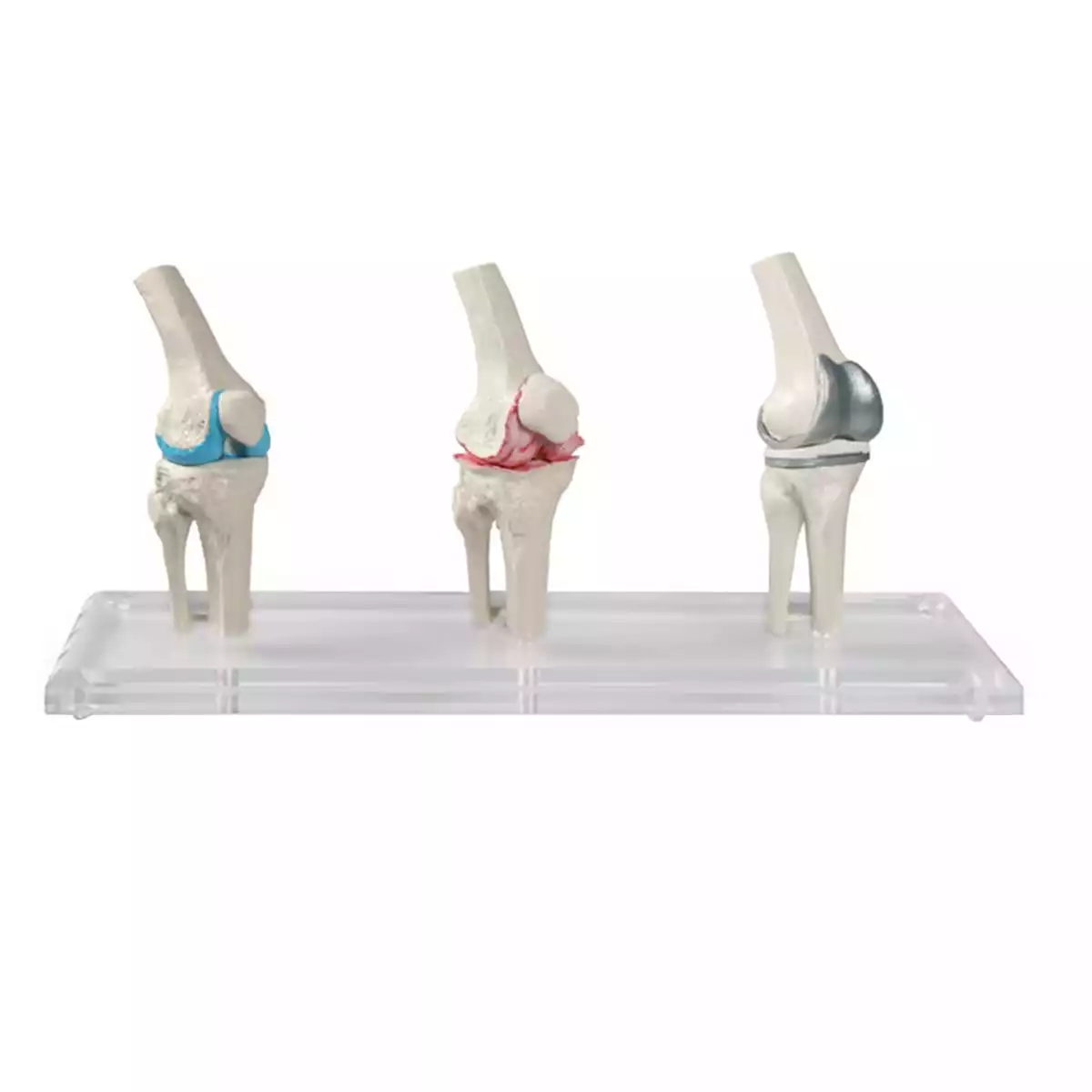  Modèle d'implant du genou