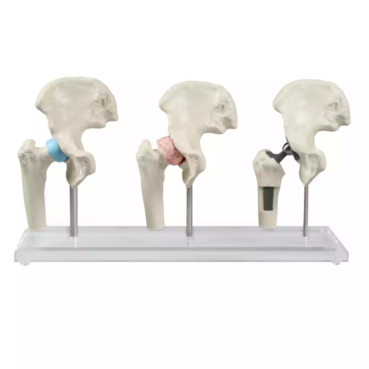  Modèle d'implant de hanche