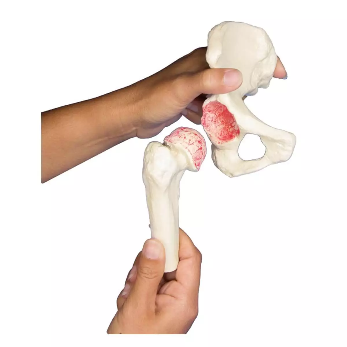  Modèle d'implant de hanche